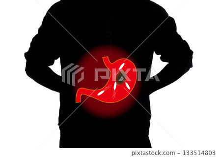 胃病、幽門螺旋桿菌、胃潰瘍 胃病、幽門螺旋桿菌、胃潰瘍 133514803