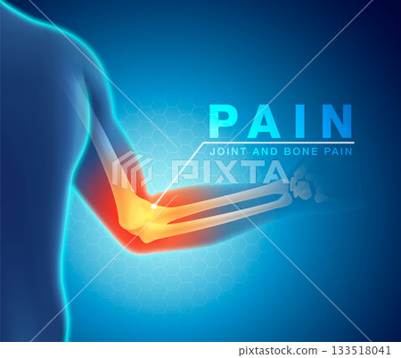 Medical depicting pain and inflammation in the human elbow joint. Highlights arthritis, joint problems or injury in the arm and bone structure. Perfect for health and anatomy content. Vector EPS file. 133518041