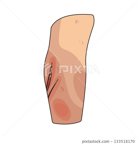 illustration of wound illustration of wound 133518170