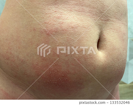 Rash on abdomen indicates scarlet fever, revealing irritation and redness 133532046