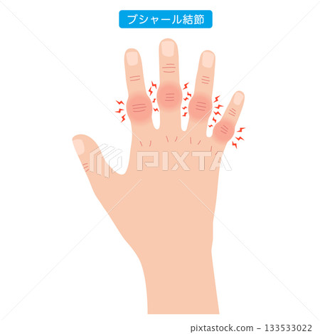 Bouchard's nodes: a disease of the finger joints 133533022