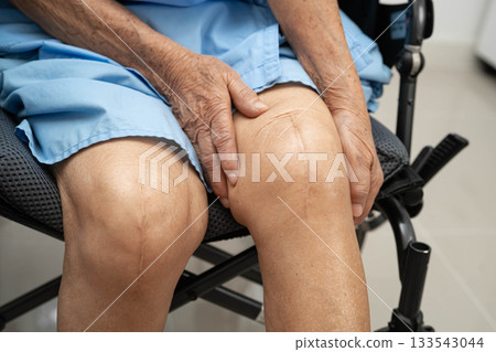 Asian elderly woman patient with scar knee replacement surgery in hospital. 133543044