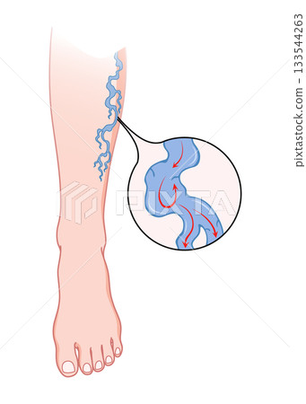 Varicose veins. Blue blood vessel visible through the skin, abnormally swollen leg. Vascular disease diagnostic and treatment. Venous insufficiency medical disease Varicose veins. Blue blood vessel visible through the skin, abnormally swollen leg. Vascular disease diagnostic and treatment. Venous insufficiency medical disease 133544263