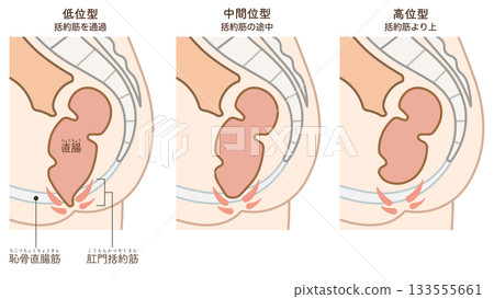 無肛症（ARM）圖示 133555661
