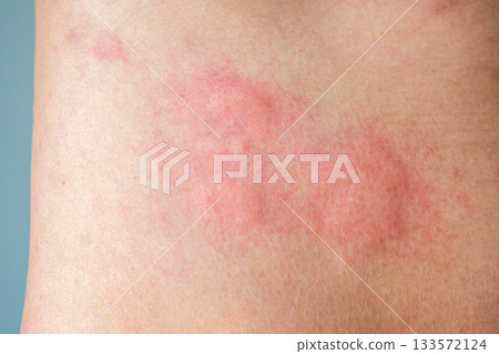 Young asian man itching and scratching on his back from allergic itchy dry skin eczema dermatitis insect bites Young asian man itching and scratching on his back from allergic itchy dry skin eczema dermatitis insect bites 133572124