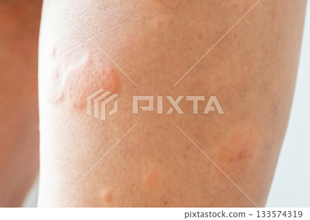 Young asian man has allergic skin rash on his legs from itchy dry skin eczema dermatitis insect bites 133574319