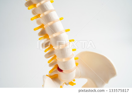 Spinal nerve and bone, Lumbar spine displaced herniated disc fragment, Model for treatment medical in the orthopedic department. Spinal nerve and bone, Lumbar spine displaced herniated disc fragment, Model for treatment medical in the orthopedic department. 133575817