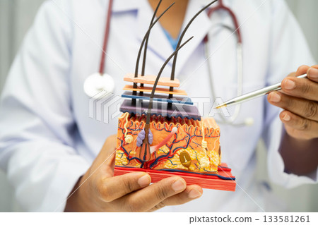 Hair transplant, Asian dermatologist doctor holding skin structure anatomy model for treatment in hospital. Hair transplant, Asian dermatologist doctor holding skin structure anatomy model for treatment in hospital. 133581261