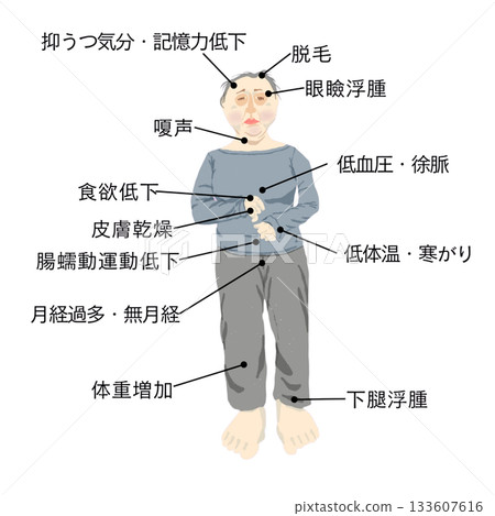 Hypothyroidism: Illustration of systemic symptoms (sensitivity to cold, edema, bradycardia, weight gain, dry skin) for medical and nursing use 133607616