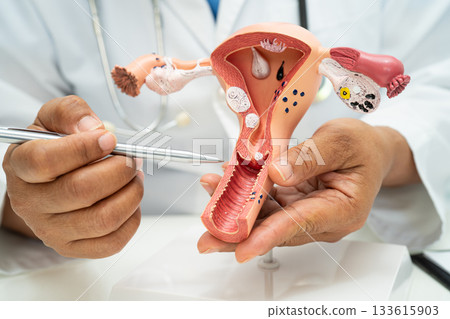 Uterus, doctor with anatomy model for study diagnosis and treatment in hospital. 133615903