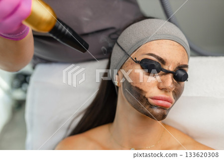 Carbon laser facial procedure in a beauty clinic with a woman wearing protective eye shields and a carbon mask during treatment. 133620308