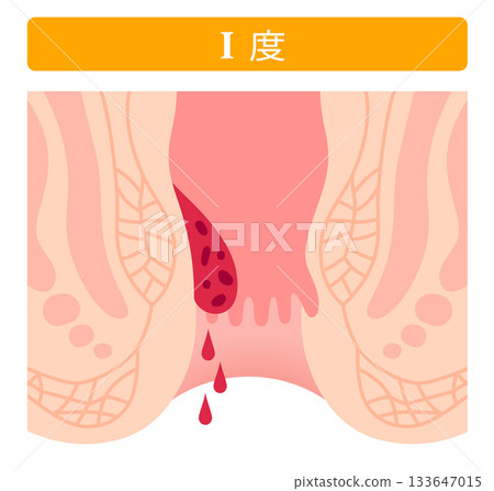 Progression of internal hemorrhoids Stage 1 Anal disease Progression of internal hemorrhoids Stage 1 Anal disease 133647015