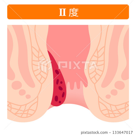 Progression of internal hemorrhoids Stage II Anal disease Progression of internal hemorrhoids Stage II Anal disease 133647017
