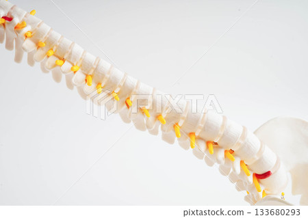 Spinal nerve and bone, Lumbar spine displaced herniated disc fragment, Model for treatment medical in the orthopedic department. 133680293