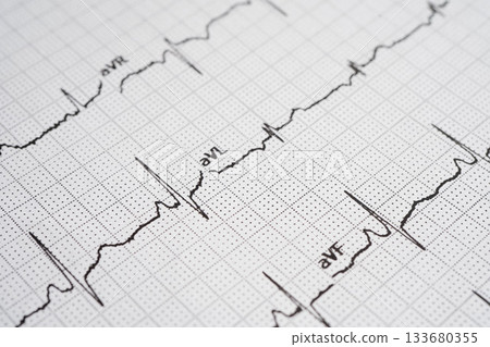 Electrocardiogram (ECG), heart wave, heart attack, cardiogram report. Electrocardiogram (ECG), heart wave, heart attack, cardiogram report. 133680355