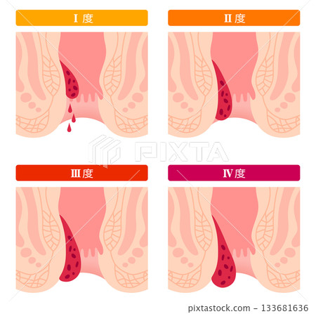 Progression of internal hemorrhoids, internal hemorrhoids grade I to IV, anal diseases Progression of internal hemorrhoids, internal hemorrhoids grade I to IV, anal diseases 133681636