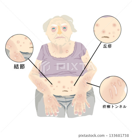Illustrations of scabies skin symptoms: papules, nodules, and scabies burrows. For medical and nursing education. 133681738