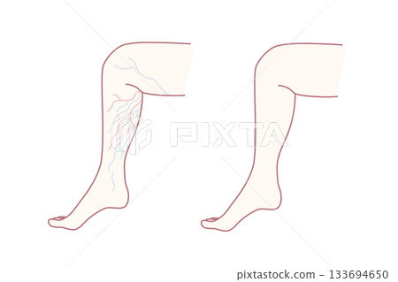 visual guide to vein health, diagram highlighting inflamed superficial veins in leg for education visual guide to vein health, diagram highlighting inflamed superficial veins in leg for education 133694650