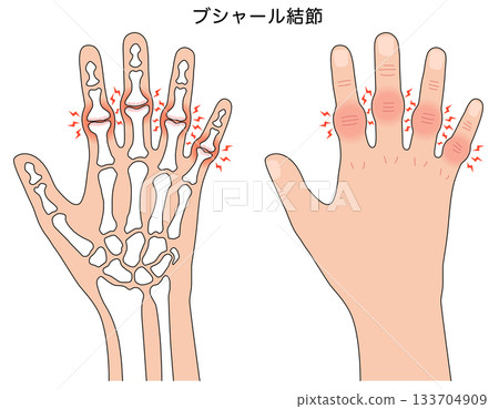 Bouchard's nodes: a disease of the finger joints 133704909