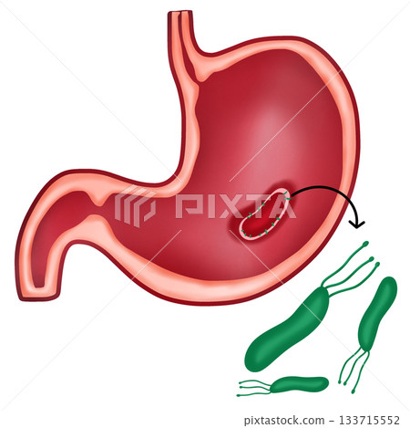 Helicobacter Pylori Bacteria Causing Peptic Ulcer Disease in Human Stomach Helicobacter Pylori Bacteria Causing Peptic Ulcer Disease in Human Stomach 133715552