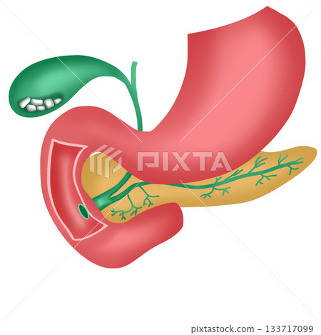 Gallstones or Cholelithiasis Disease, Stones in Human Gallbladder and Digestive System Diagram 133717099