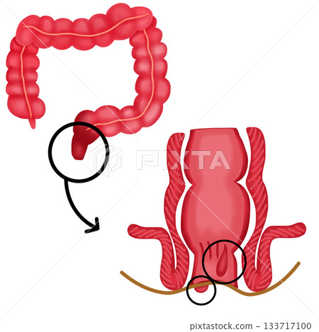 Internal and External Hemorrhoids in Rectum and Anus Internal and External Hemorrhoids in Rectum and Anus 133717100