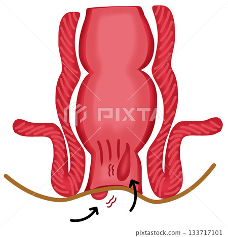 Hemorrhoids or Anal Fissure - Rectum and Anus Medical Condition Diagram, hand drawn watercolor illustration 133717101