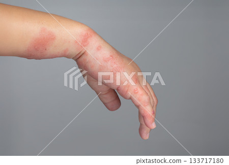 Shingles, Zoster or Herpes Zoster symptoms on arm. Shingles, Zoster or Herpes Zoster symptoms on arm. 133717180