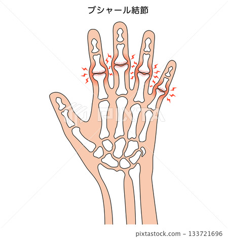 Bouchard's nodes: a disease of the finger joints 133721696
