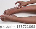 Woman's hands gently removing flaky skin from sunburned legs, showcasing detailed dermatological care and healing after excessive UV exposure. 133721868