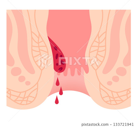 Progression of internal hemorrhoids Stage 1 Anal disease Progression of internal hemorrhoids Stage 1 Anal disease 133721941