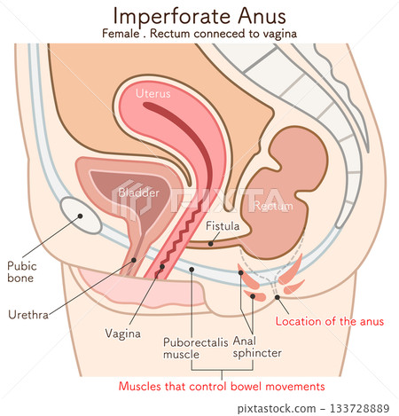 女性肛門閉鎖(ARM)圖示 女性肛門閉鎖(ARM)圖示 133728889