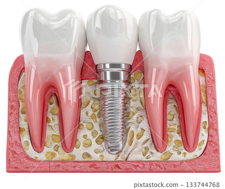 Dental implant, artificial tooth roots into jaw isolated on white background PNG transparent clipart. Dental implant, artificial tooth roots into jaw isolated on white background PNG transparent clipart. 133744768