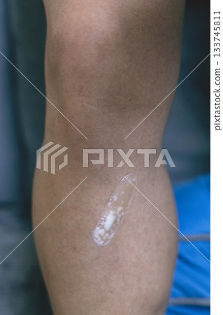 腿部受傷的急救處理:用墊子包紮 腿部受傷的急救處理:用墊子包紮 133745811