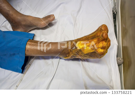 Patient's Foot Wrapped in Surgical Film 133758221