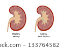 Healthy kidney compared to kidney with kidney stones forming inside 133764582