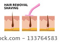 Hair follicle before, during and after shaving with razor blade 133764583