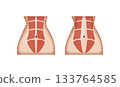 Diastasis recti, normal abdominal muscles and separated abdominal muscles 133764585