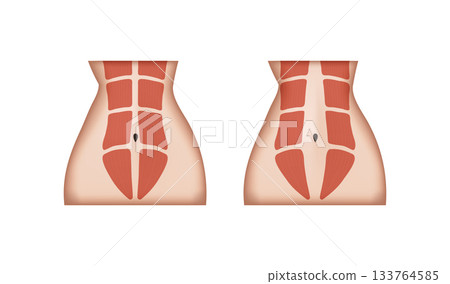 Diastasis recti, normal abdominal muscles and separated abdominal muscles Diastasis recti, normal abdominal muscles and separated abdominal muscles 133764585