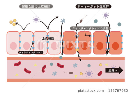 小腸上皮細胞橫切面示意圖與腸漏症候群的簡明易懂示意圖 133767980