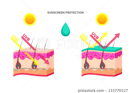 Cartoon Color Sunscreen Protection Template Placard Poster Card Uvb and Uva Rays Penetrate into Human Skin Layered. Vector illustration of Before and After Sunscreen 133776527