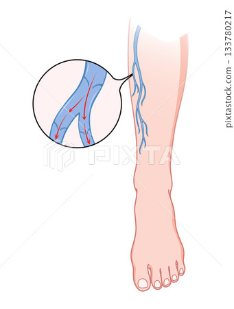Varicose veins. Blue blood vessel visible through the skin, abnormally swollen leg. Vascular disease diagnostic and treatment. Venous insufficiency medical disease Varicose veins. Blue blood vessel visible through the skin, abnormally swollen leg. Vascular disease diagnostic and treatment. Venous insufficiency medical disease 133780217