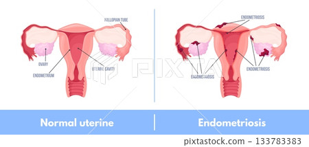 Endometriosis. Female uterus endometrium, infertility fertility womb reproductive system dysmenorrhea adenomyosis cyst cancer medical education poster, neat vector illustration Endometriosis. Female uterus endometrium, infertility fertility womb reproductive system dysmenorrhea adenomyosis cyst cancer medical education poster, neat vector illustration 133783383