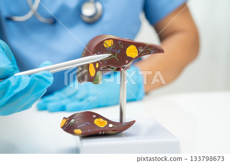 Cirrhosis, Liver cancer, fatty liver, Asian doctor with liver human anatomy model in World Hepatitis Day at hospital. 133798673