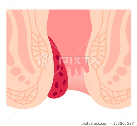 內痔進展至第三期肛門疾病 內痔進展至第三期肛門疾病 133803557