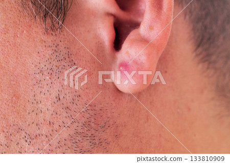 Skin condition on the ear of a young man showing irritation and raised bump near facial hair, red pimple Skin condition on the ear of a young man showing irritation and raised bump near facial hair, red pimple 133810909