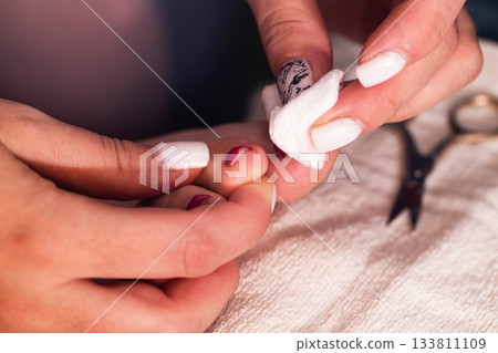 Nail care session focusing on cleaning and tidying toes in a wellness salon during a relaxing afternoon. A festering finger with an ingrown nail. 133811109