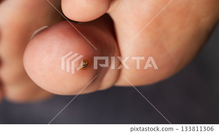 Direct Overhead View Of A Toe Wart. This Macro Image Displays The Verruca's Structure. 133811306