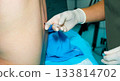 Anesthesiologist's hands holding an epidural anesthesia needle. 133814702