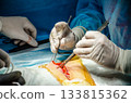 The surgeon operates on a patient with surgical instruments. 133815362